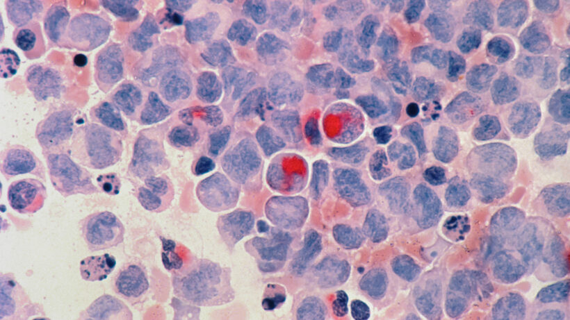 Blutkrebs unter dem Mikroskop